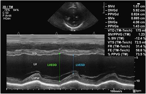 lv edv normal range|left internal dimension in systole.